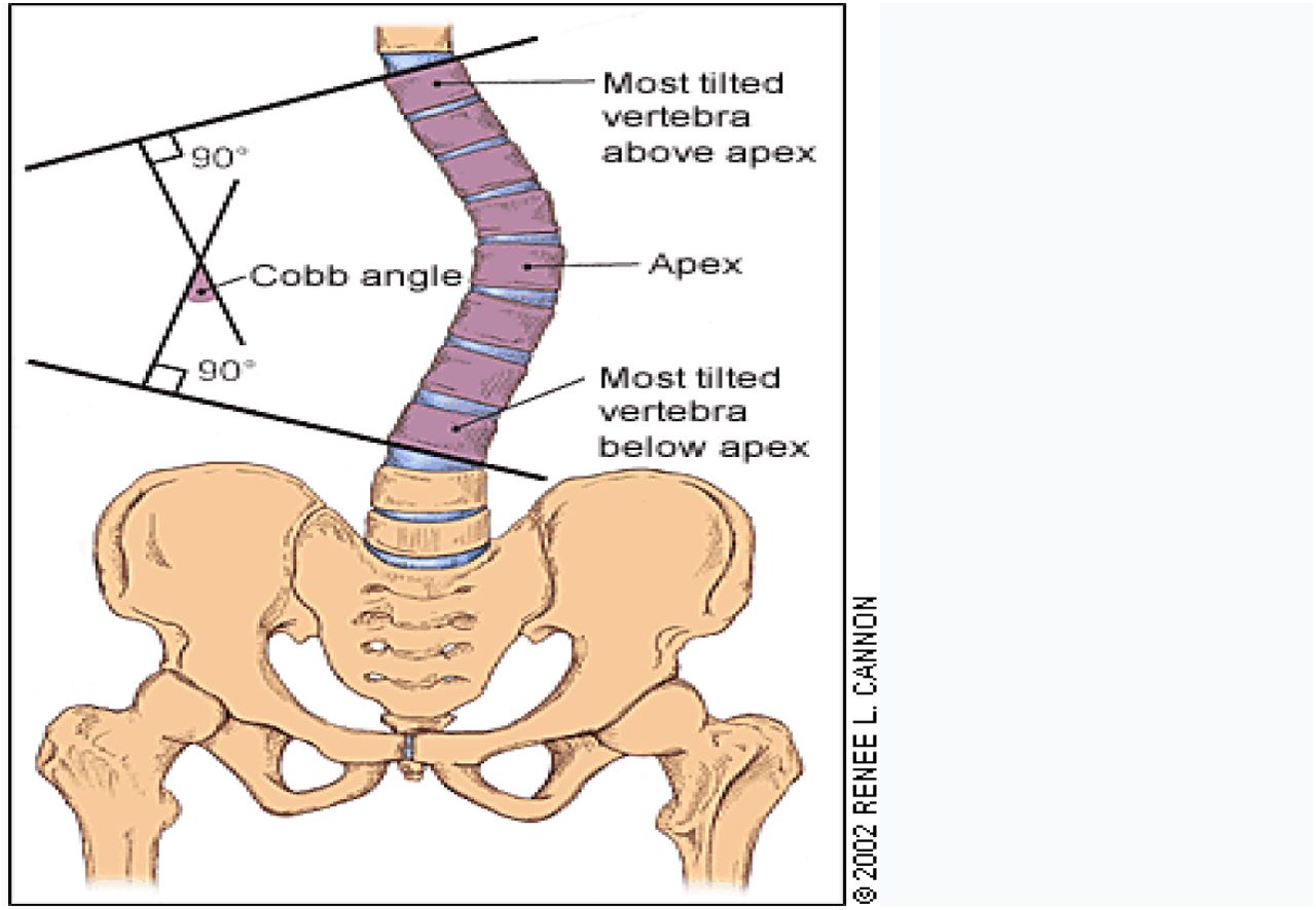 Brace Tutorial: Structural high thoracic curves – how to manage