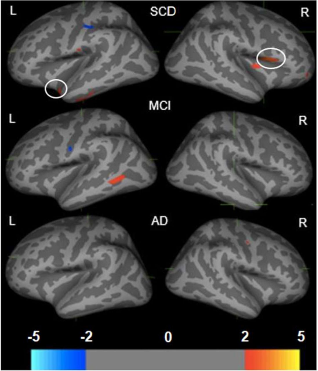 Frontiers  Hearing loss and its link to cognitive impairment and dementia