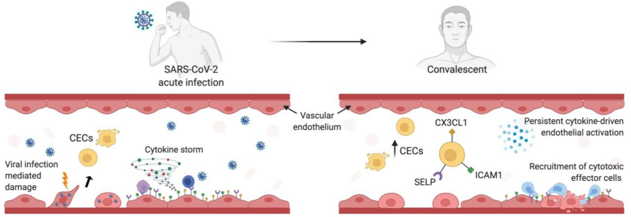 Endothelial cell infection and endotheliitis in COVID-19 - The Lancet
