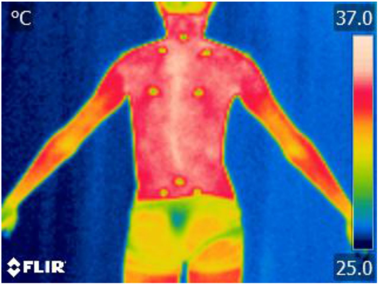 Can infrared camera images be used for screening in Adolescent Idiopathic Scoliosis? medRxiv