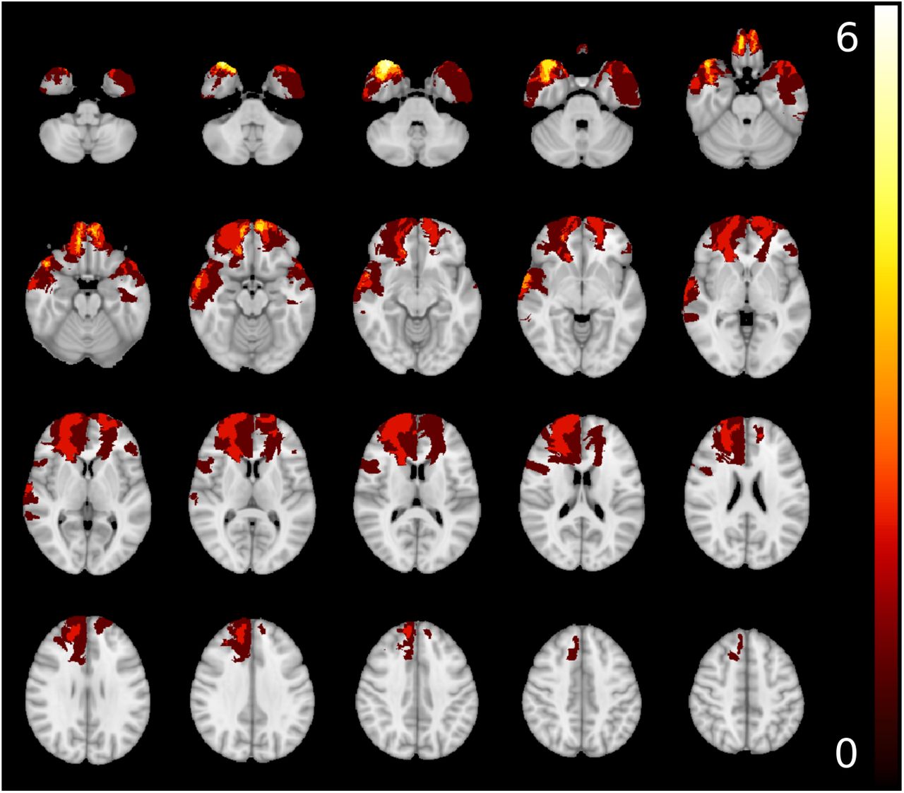 Traumatic brain injury in homeless and marginally housed individuals: a  systematic review and meta-analysis - The Lancet Public Health