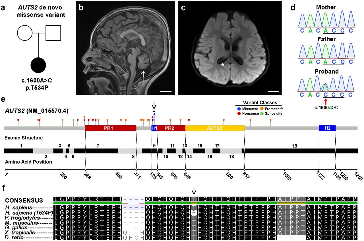 Rubinstein-Taybi syndrome 2 with cerebellar abnormality and neural