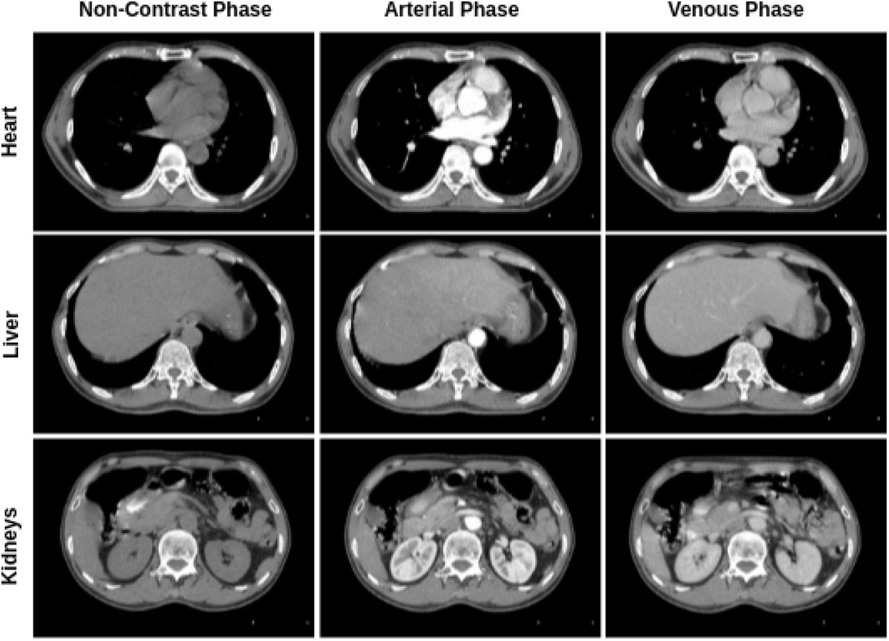 Phase Recognition In Contrast Enhanced Ct Scans Based On Deep Learning