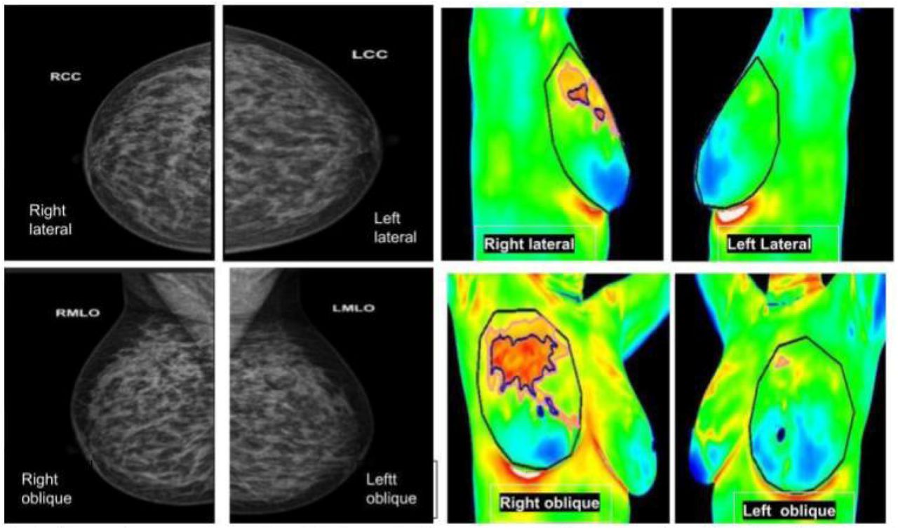 Analysis of Breast Thermograms Using Asymmetry in Infra-Mammary