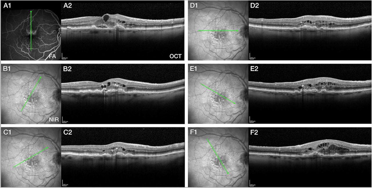 Using the Double-Layer Sign to Predict Subclinical Macular  Neovascularization - American Academy of Ophthalmology