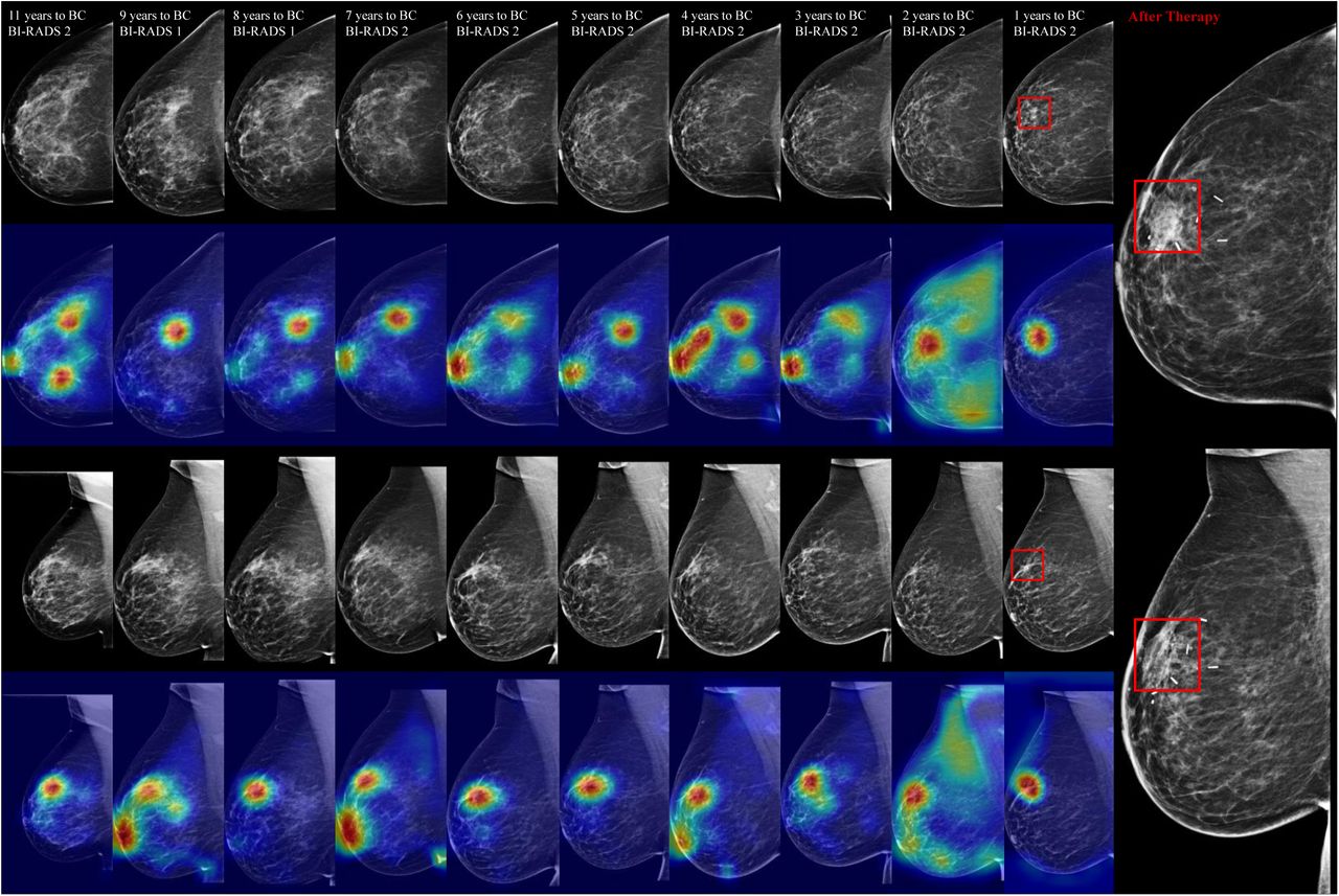 Predicting up to 10 year breast cancer risk using longitudinal
